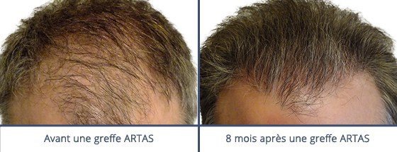 عيادة زراعة الشعر في باريس - Clinic of Hair Transplant in Paris