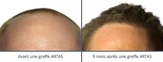 عيادة زراعة الشعر في باريس - Clinic of Hair Transplant in Paris