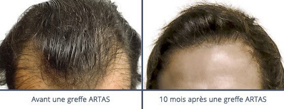 عيادة زراعة الشعر في باريس - Clinic of Hair Transplant in Paris
