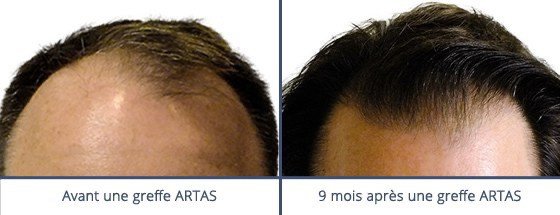 عيادة زراعة الشعر في باريس - Clinic of Hair Transplant in Paris