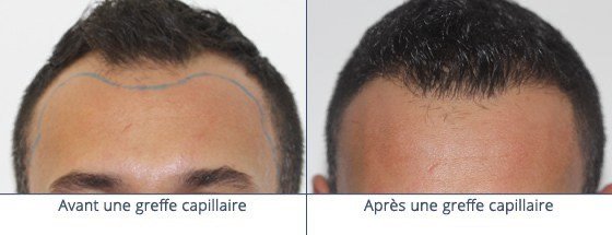 عيادة زراعة الشعر في باريس - Clinic of Hair Transplant in Paris
