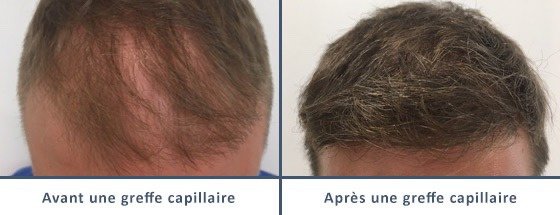 عيادة زراعة الشعر في باريس - Clinic of Hair Transplant in Paris