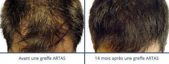 عيادة زراعة الشعر في باريس - Clinic of Hair Transplant in Paris
