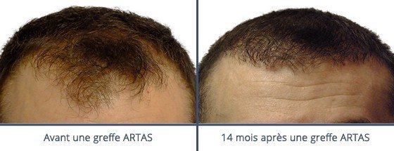 عيادة زراعة الشعر في باريس - Clinic of Hair Transplant in Paris