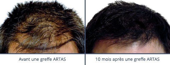 عيادة زراعة الشعر في باريس - Clinic of Hair Transplant in Paris