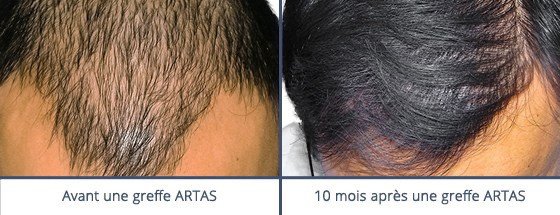 عيادة زراعة الشعر في باريس - Clinic of Hair Transplant in Paris