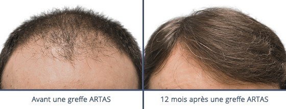 عيادة زراعة الشعر في باريس - Clinic of Hair Transplant in Paris