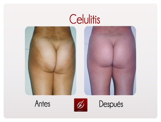 Clínica Láser Puebla - Clínica Láser Puebla