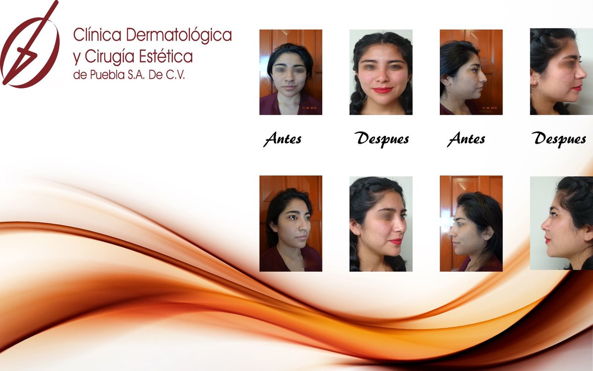 Clínica Láser Puebla - Clínica Láser Puebla