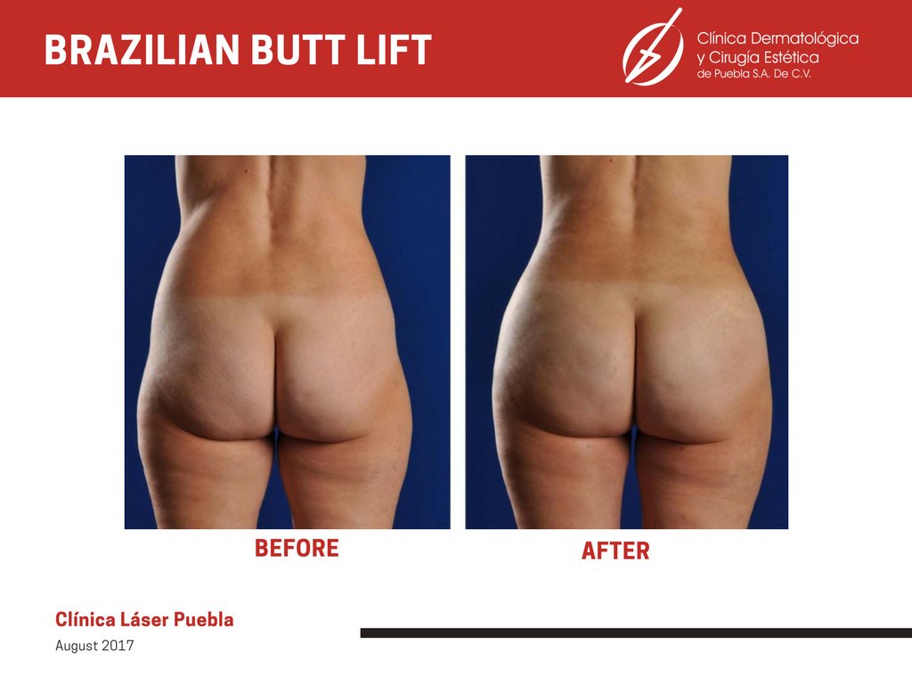 Clínica Láser Puebla - Clínica Láser Puebla