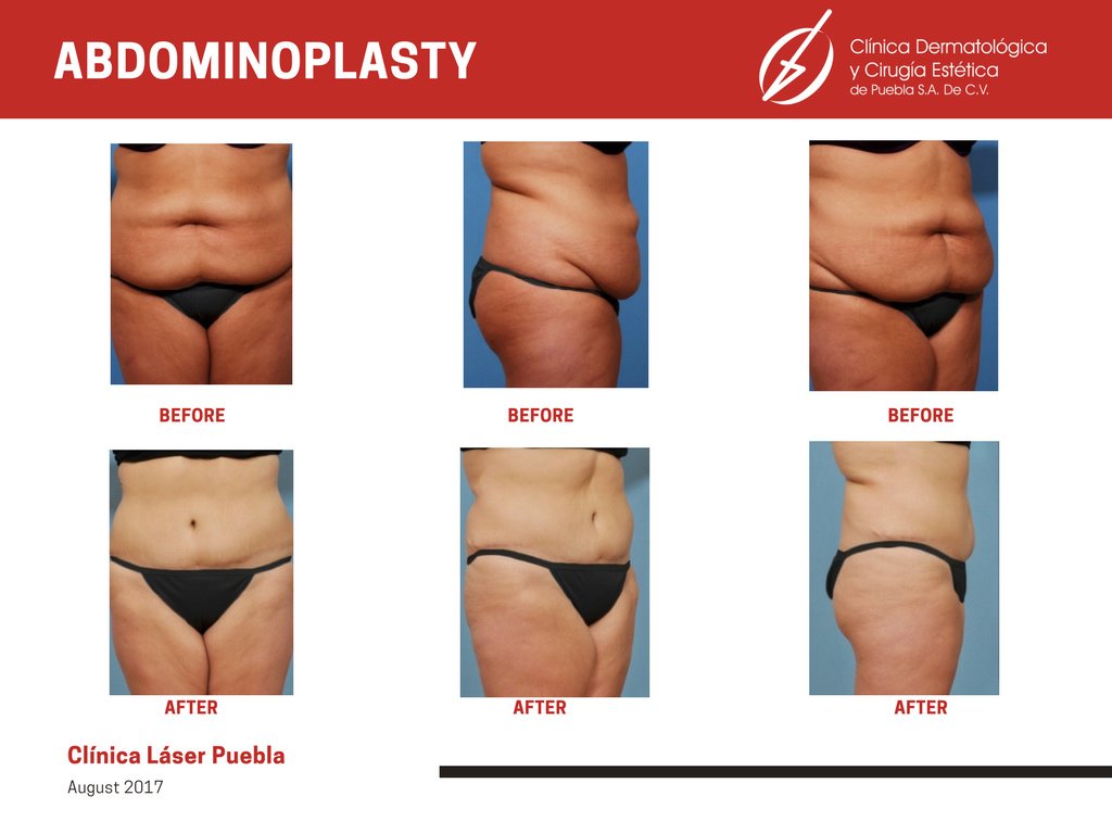 Clínica Láser Puebla - Clínica Láser Puebla