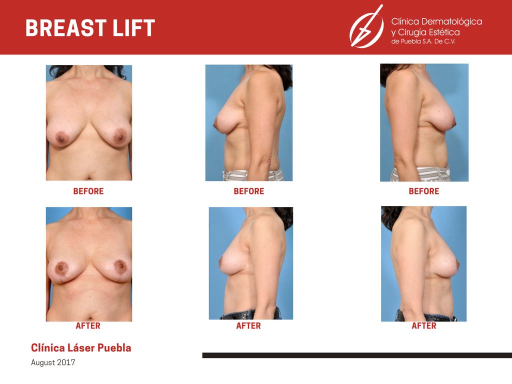 Clínica Láser Puebla - Clínica Láser Puebla