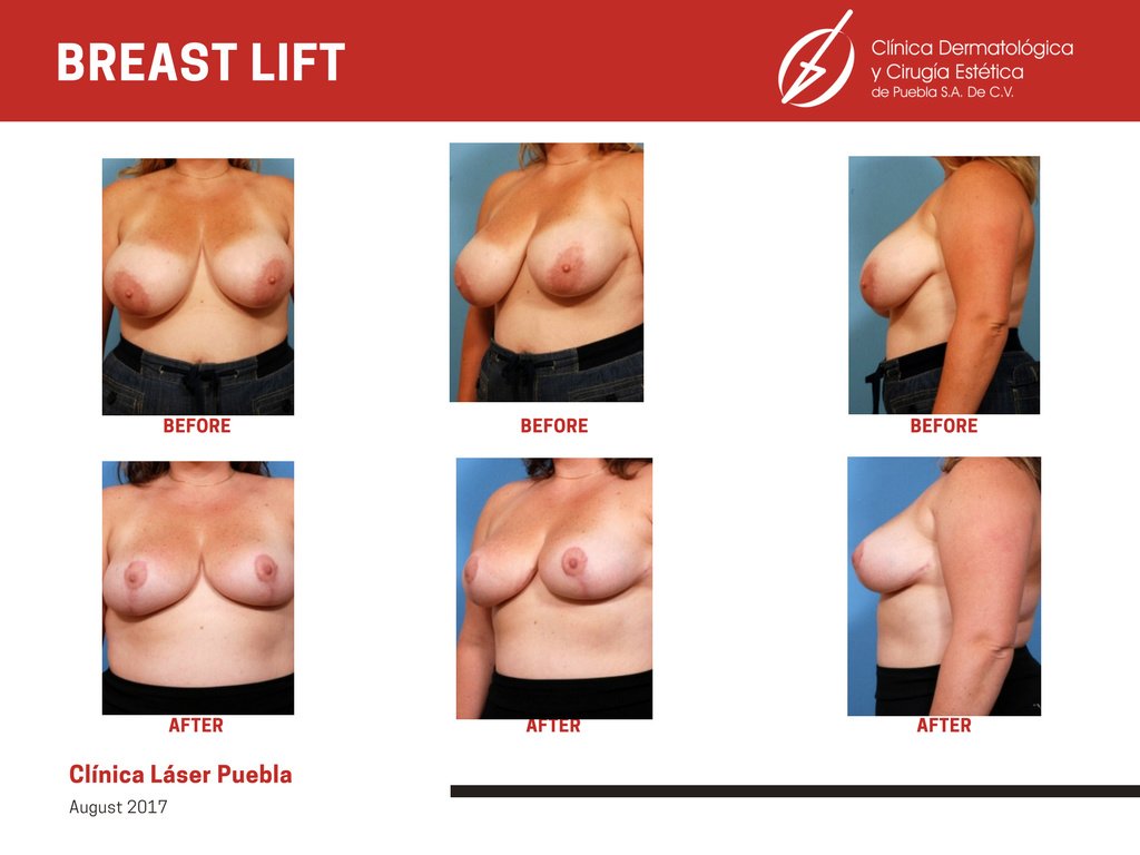 Clínica Láser Puebla - Clínica Láser Puebla