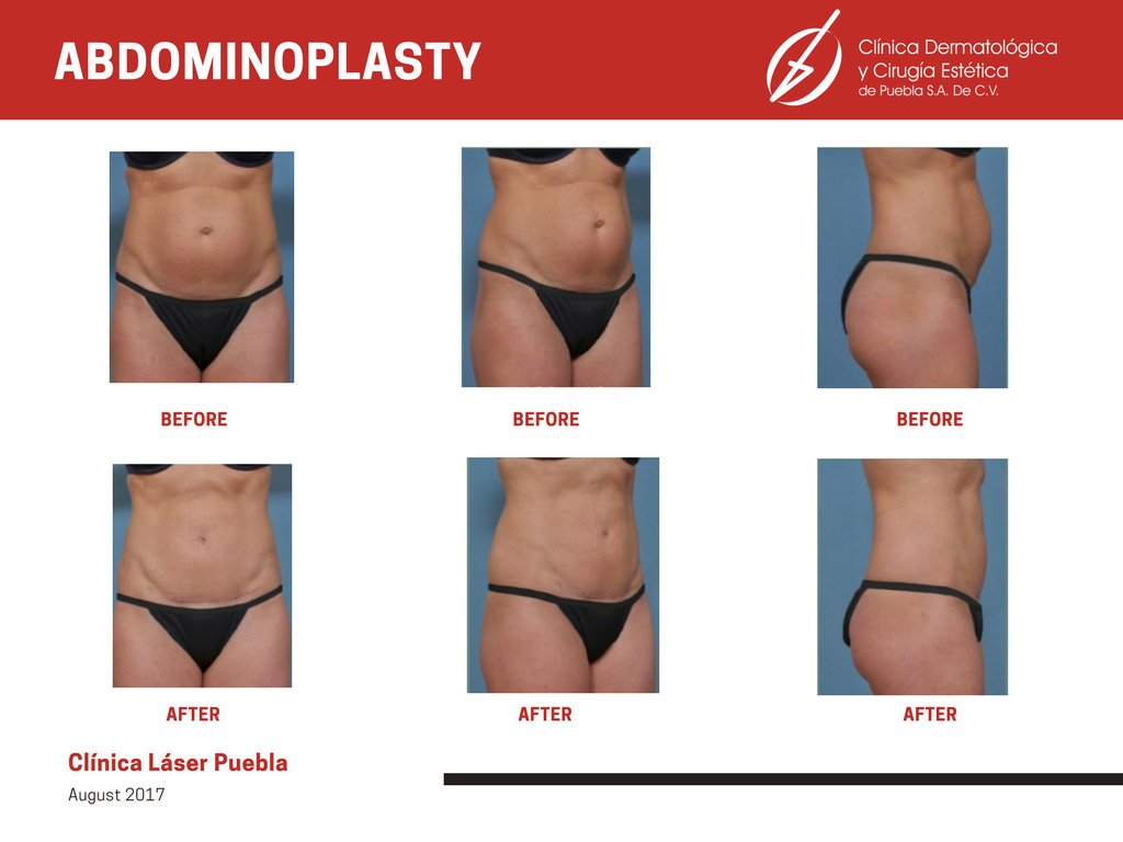 Clínica Láser Puebla - Clínica Láser Puebla