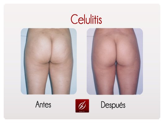 Clínica Láser Puebla - Clínica Láser Puebla