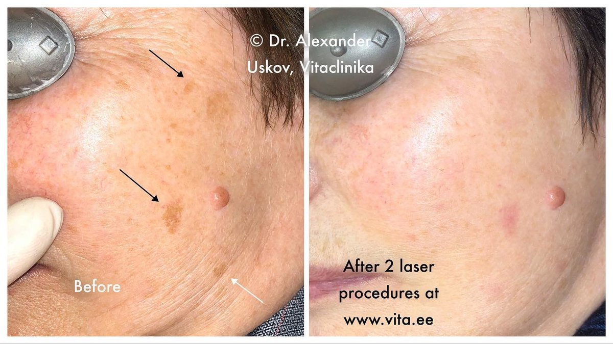 Confido Laserravi Clinic - Confido Laserravi Clinic