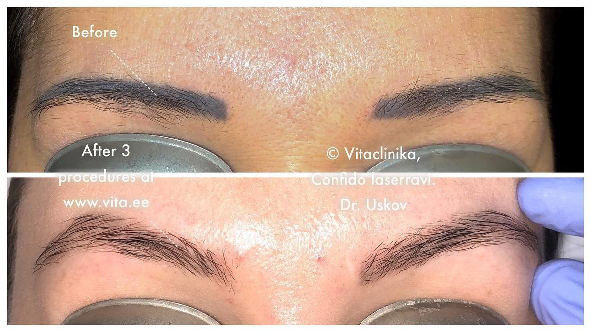 Confido Laserravi Clinic - Confido Laserravi Clinic