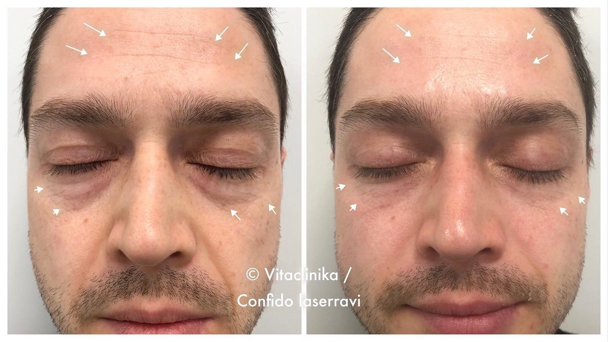 Confido Laserravi Clinic - Confido Laserravi Clinic