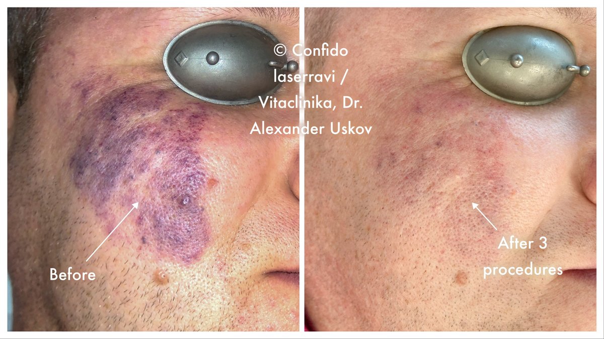 Confido Laserravi Clinic - Confido Laserravi Clinic