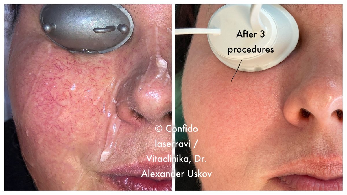 Confido Laserravi Clinic - Confido Laserravi Clinic