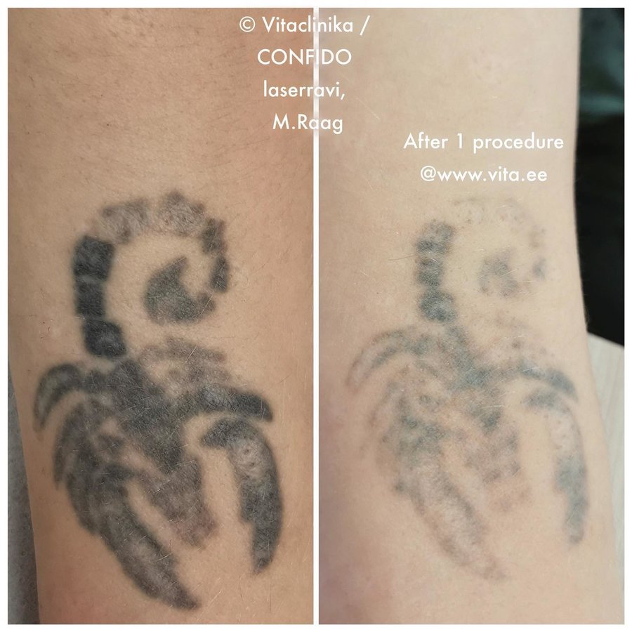 Confido Laserravi Clinic - Confido Laserravi Clinic