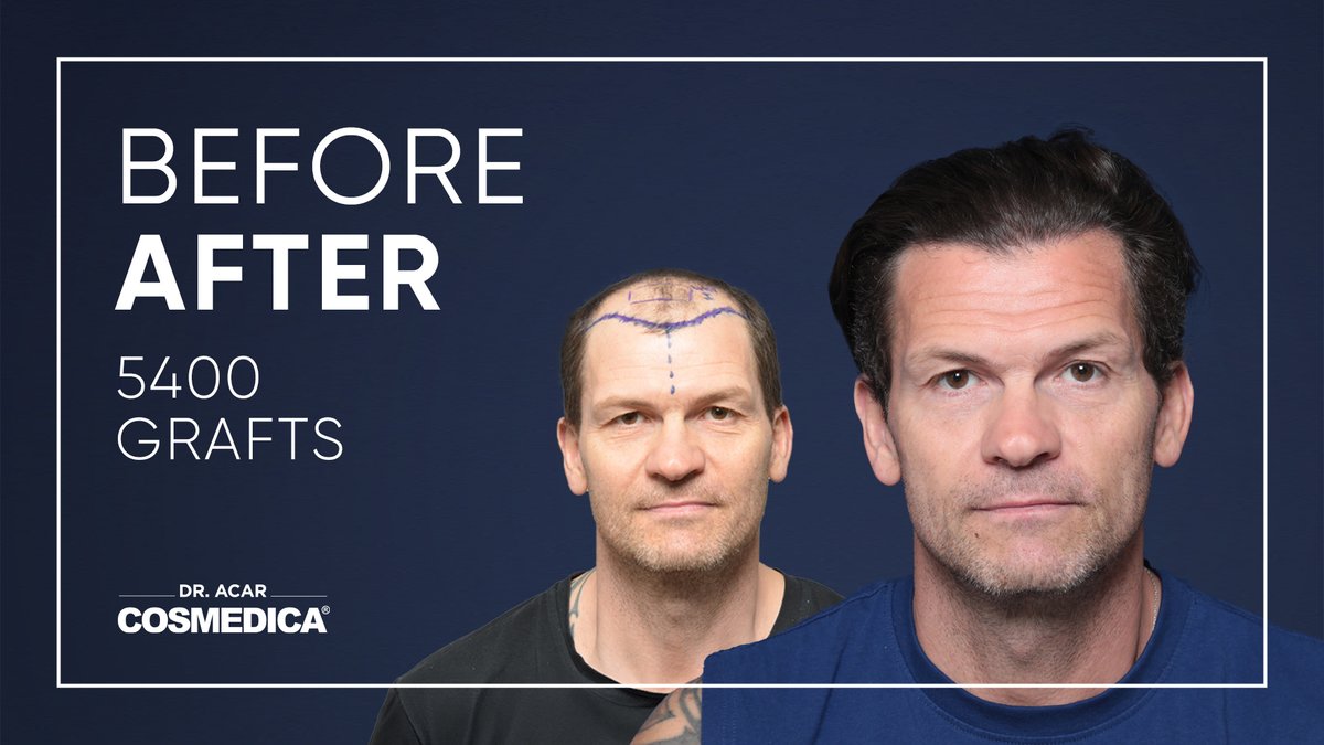 Cosmedica Clinic Hair Transplant - Cosmedica Clinic Hair Transplant