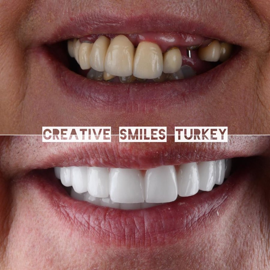 Creative Smiles Turkey - Creative Smiles Turkey