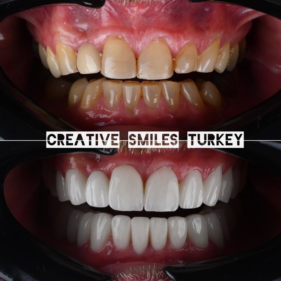 Creative Smiles Turkey - Creative Smiles Turkey