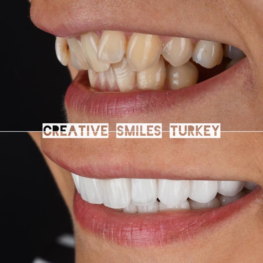 Creative Smiles Turkey - Creative Smiles Turkey
