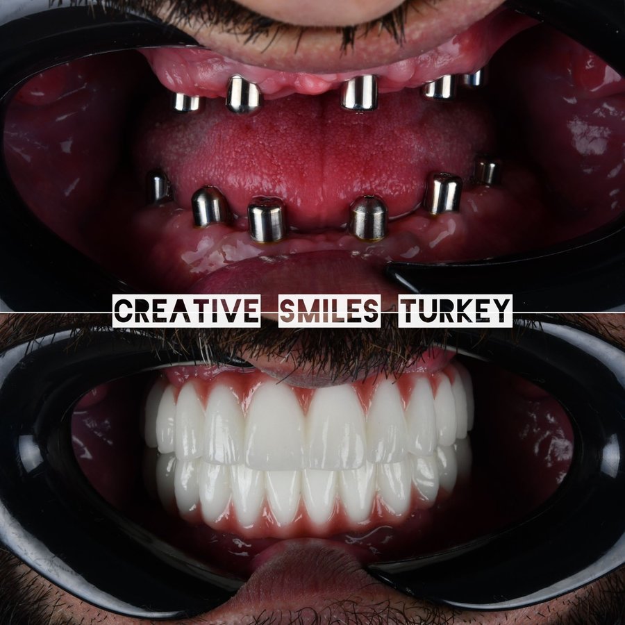 Creative Smiles Turkey - Creative Smiles Turkey