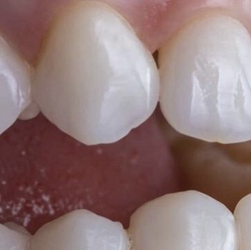 CROWN ESTETIK الأسنان - CROWN ESTETIK DENTAL