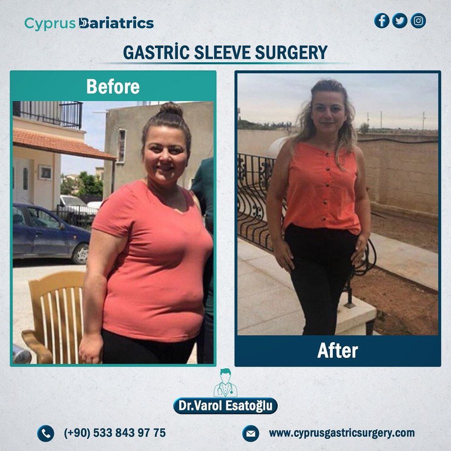 Cyprus Bariatrics - Dr. Varol Esatoglu - Cyprus Bariatrics - Dr. Varol Esatoglu