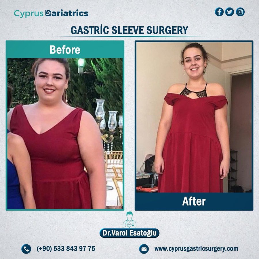 Cyprus Bariatrics - Dr. Varol Esatoglu - Cyprus Bariatrics - Dr. Varol Esatoglu