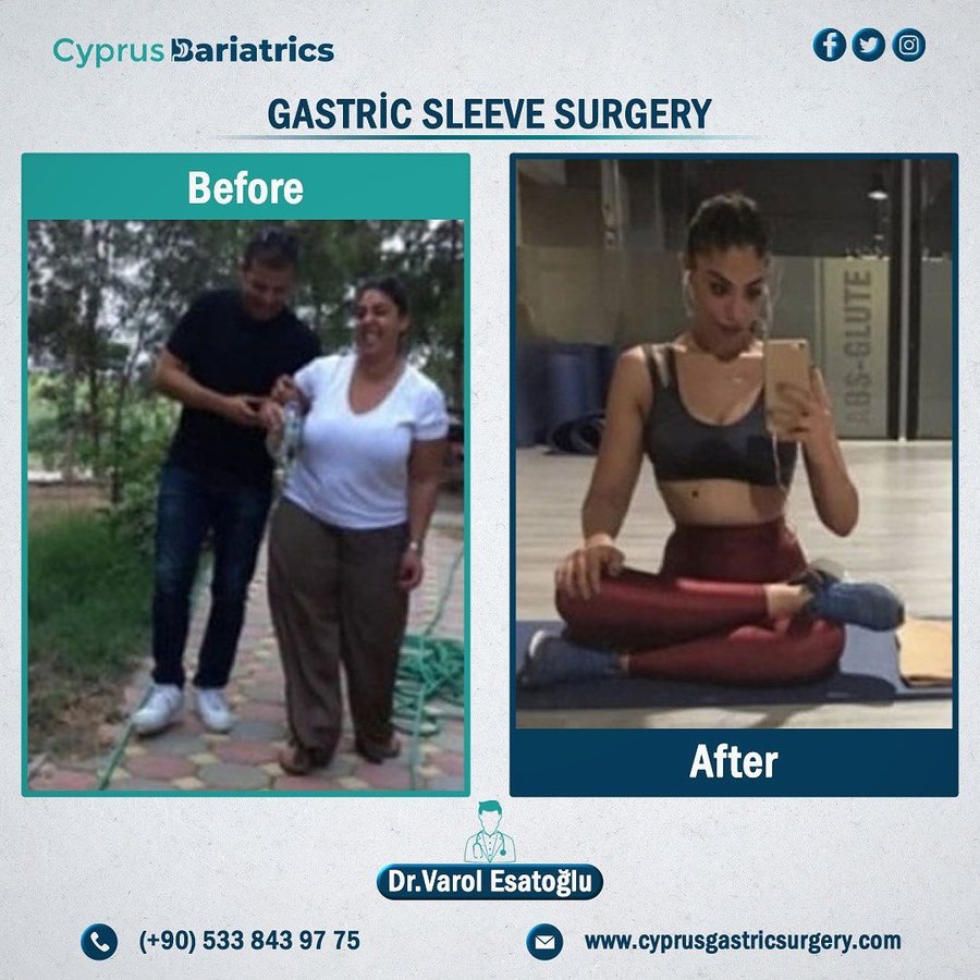 Cyprus Bariatrics - Dr. Varol Esatoglu - Cyprus Bariatrics - Dr. Varol Esatoglu