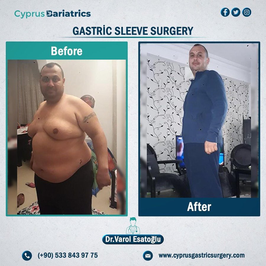 Cyprus Bariatrics - Dr. Varol Esatoglu - Cyprus Bariatrics - Dr. Varol Esatoglu