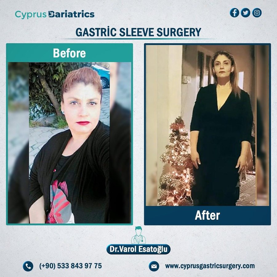 Cyprus Bariatrics - Dr. Varol Esatoglu - Cyprus Bariatrics - Dr. Varol Esatoglu