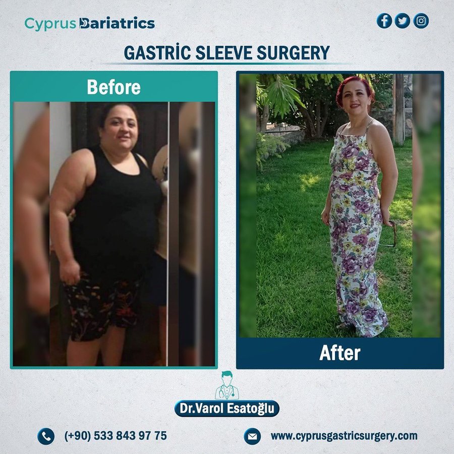 Cyprus Bariatrics - Dr. Varol Esatoglu - Cyprus Bariatrics - Dr. Varol Esatoglu