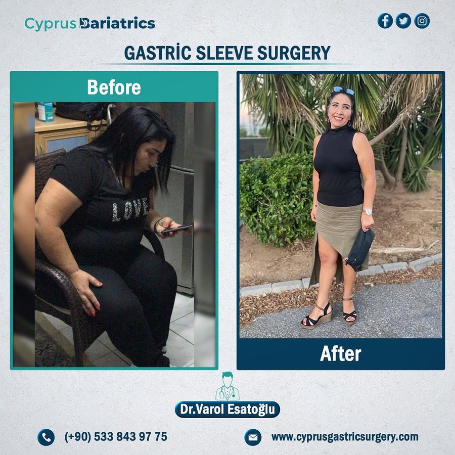Cyprus Bariatrics - Dr. Varol Esatoglu - Cyprus Bariatrics - Dr. Varol Esatoglu