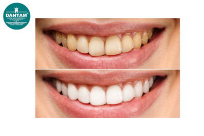 Dantam Dental - Best Dental Clinic in Kondapur - Dantam Dental - Best Dental Clinic in Kondapur