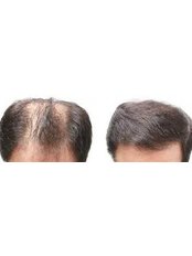 Delhi Hair Clinic - Jalandhar - Delhi Hair Clinic - Jalandhar