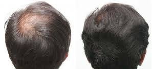 عيادة دلهي للشعر - سورات - Delhi Hair Clinic - Surat