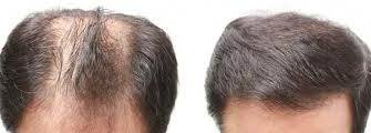 عيادة دلهي للشعر -Visakhapatnam - Delhi Hair Clinic -Visakhapatnam