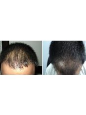 عيادة دلهي للشعر -Visakhapatnam - Delhi Hair Clinic -Visakhapatnam