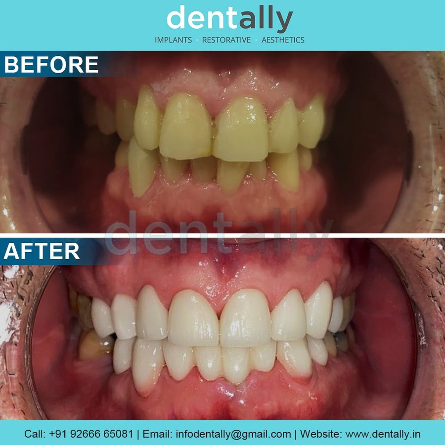 Dent Ally - Dent Ally