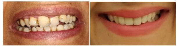 Dent Ally - Dent Ally