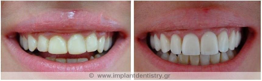Dent Artistry Contemporary Prosthodontics - Dent Artistry Contemporary Prosthodontics