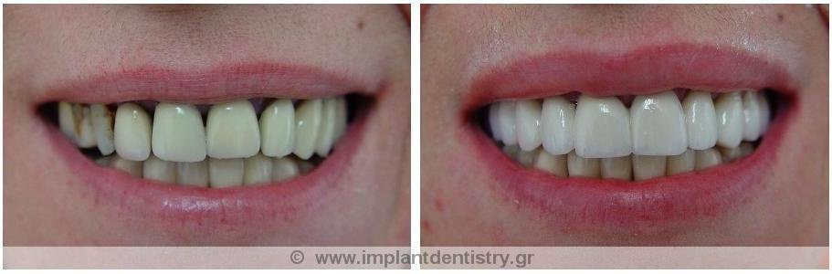 Dent Artistry Contemporary Prosthodontics - Dent Artistry Contemporary Prosthodontics