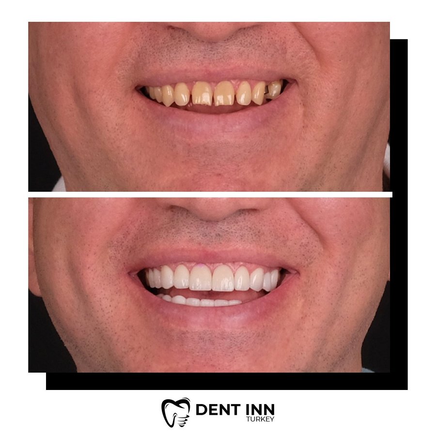 Dent Inn Turkey - Dent Inn Turkey