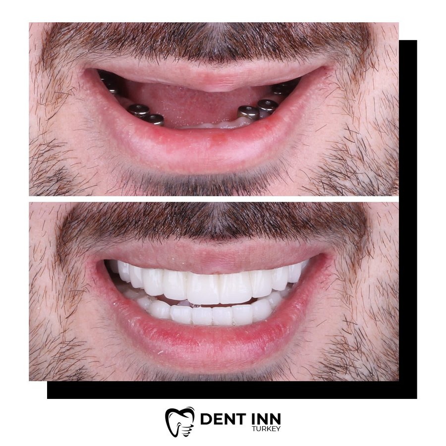 Dent Inn Turkey - Dent Inn Turkey