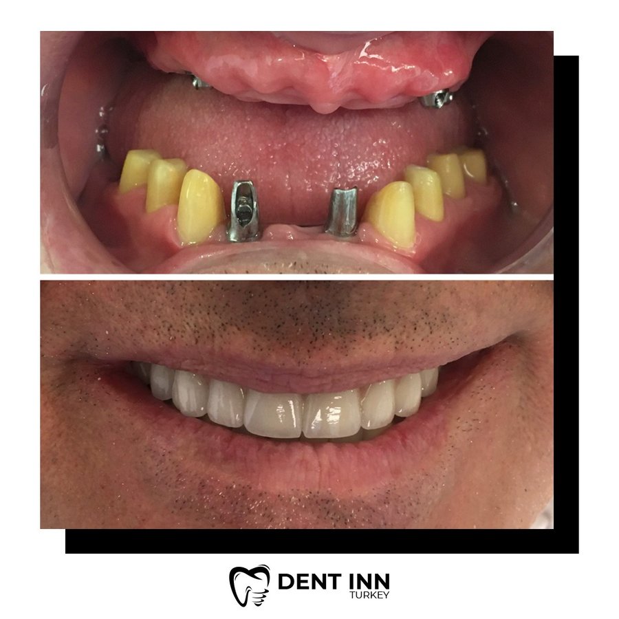 Dent Inn Turkey - Dent Inn Turkey